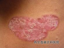 银屑病是否传染呢