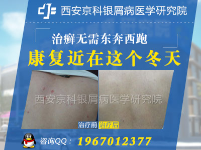 孕期银屑病该怎么办